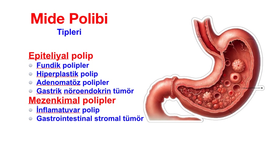 Mide polibinin tipleri